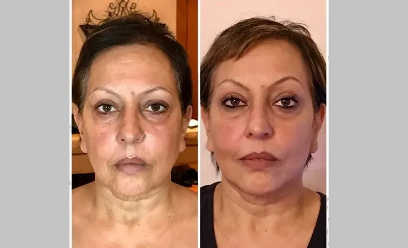 هایفوتراپی چیست؟ ۷ مزایای هایفوتراپی برای جوانسازی پوست