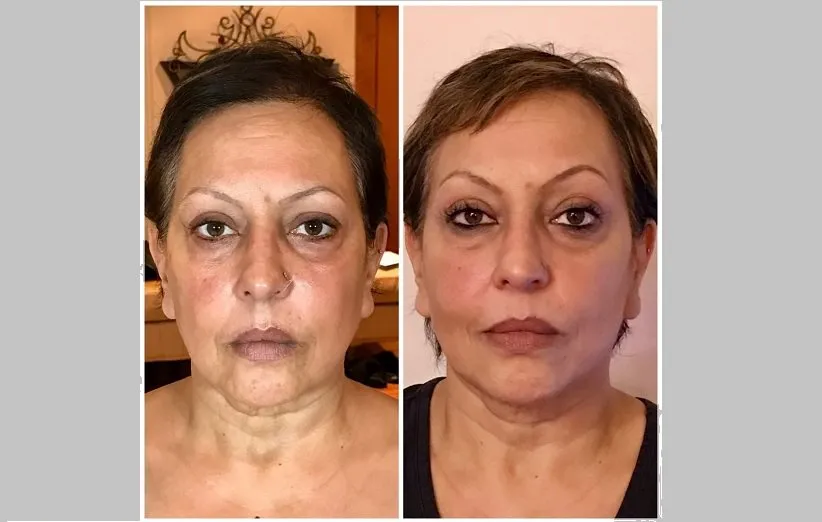 هایفوتراپی چیست؟ ۷ مزایای هایفوتراپی برای جوانسازی پوست