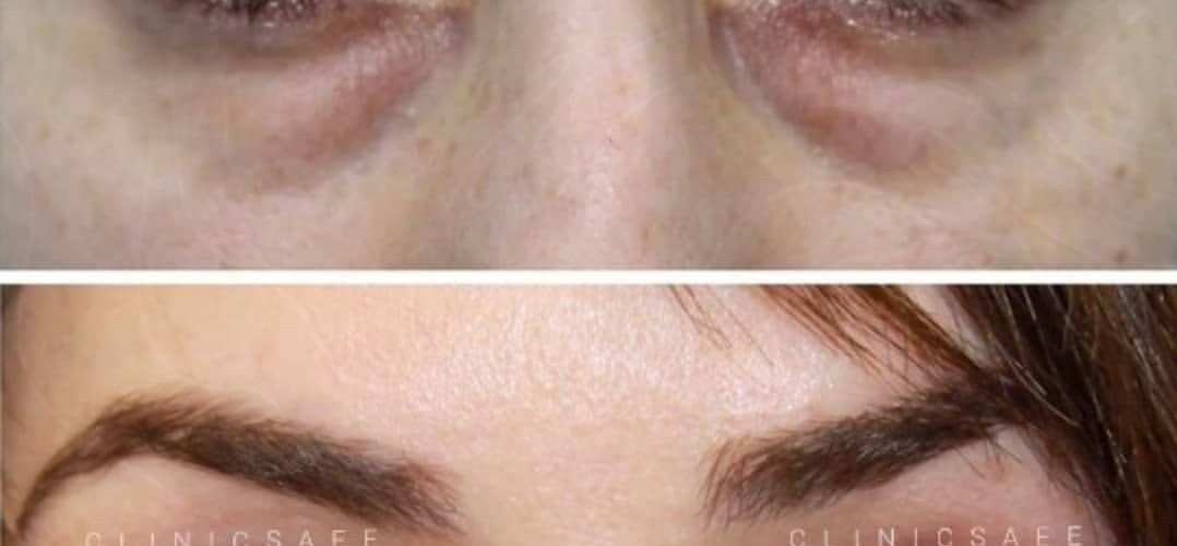 خطرات بلفاروپلاستی ارزان؛ از خشکی چشم تا ناهماهنگی پلک