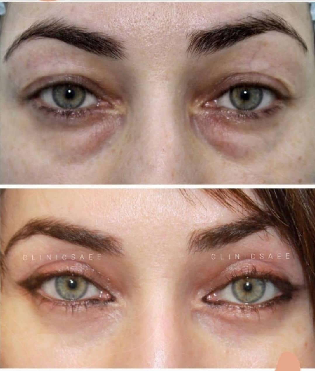 خطرات بلفاروپلاستی ارزان؛ از خشکی چشم تا ناهماهنگی پلک