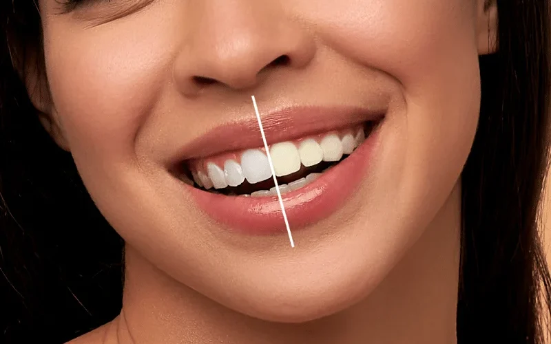 5 دروغ کلینیک‌های غیرتخصصی درباره ماندگاری کامپوزیت