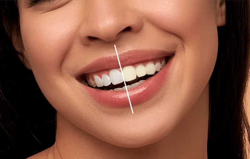 5 دروغ کلینیک‌های غیرتخصصی درباره ماندگاری کامپوزیت