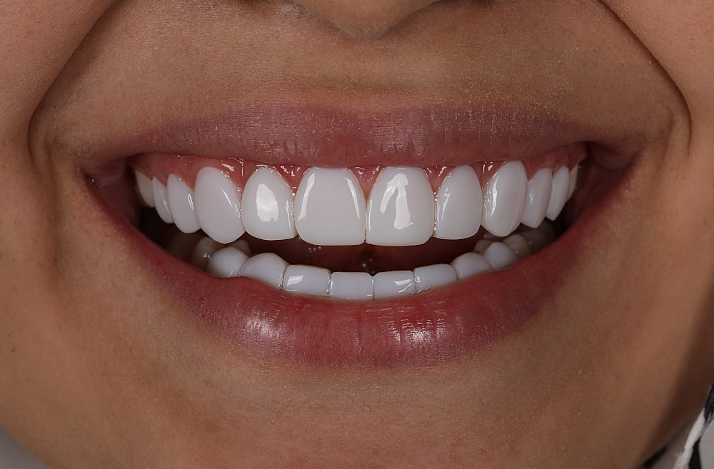 جرم‌گیری و تمیز کردن دندان