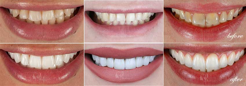 10 سؤال حیاتی قبل از لمینت که باید از خود بپرسید