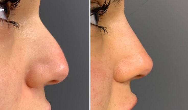 معجزه رینوپلاستی + زیبایی بدون جراحی در سال 2025