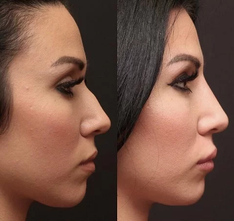 بهبود بینی بدون جراحی: معجزه فیلر و لیزر! (در سال ۲۰۲۵)