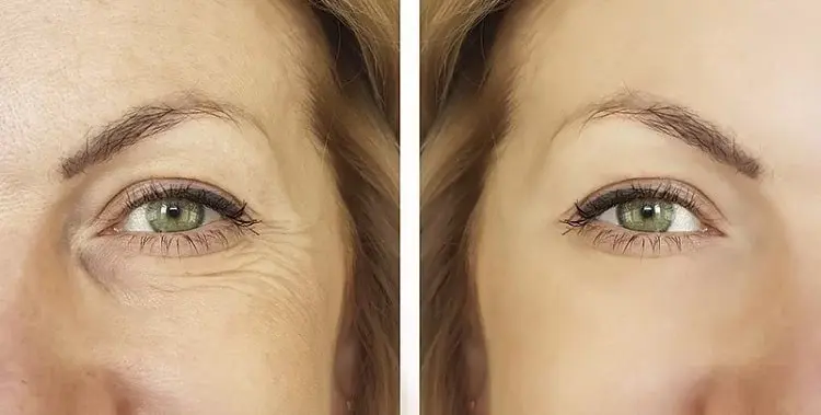 ۷ دروغ رایج درباره لیفت پلک با لیزر در کلینیک‌های غیرمجاز