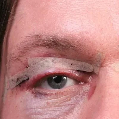 هشدار! عوارض بلفاروپلاستی غیراصولی: ۷ نشانه کلینیک غیرمجاز