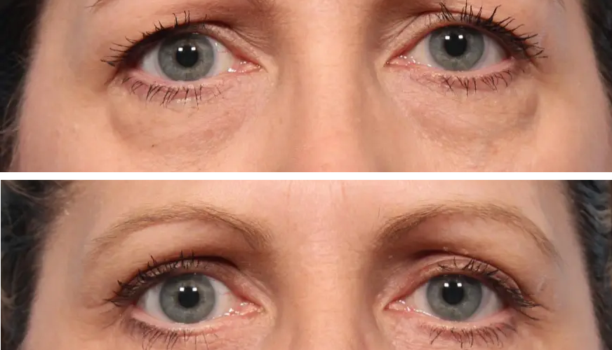 ۱۰ هشدار ضروری قبل از جراحی پلک که هر بیمار باید بداند!