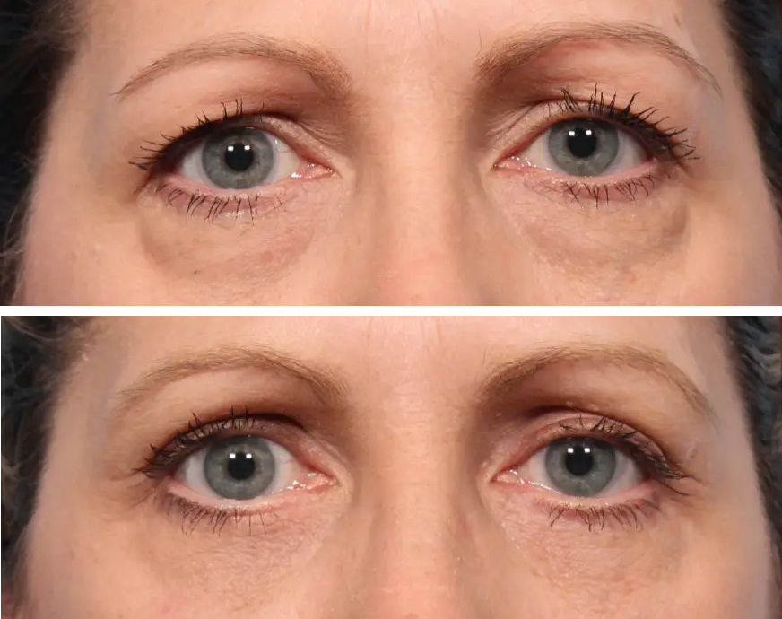 ۱۰ هشدار ضروری قبل از جراحی پلک که هر بیمار باید بداند!