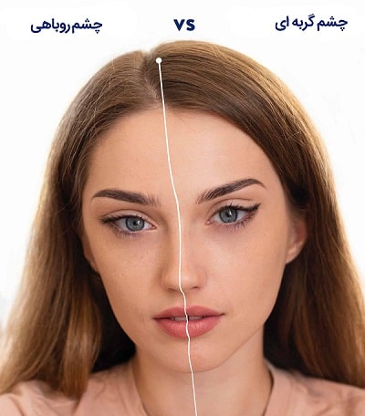 جراحی پلک گربه‌ای در کلینیک زیبایی ماهتا تهرانسر
