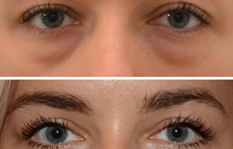 بهترین کلینیک بلفاروپلاستی تهرانسر