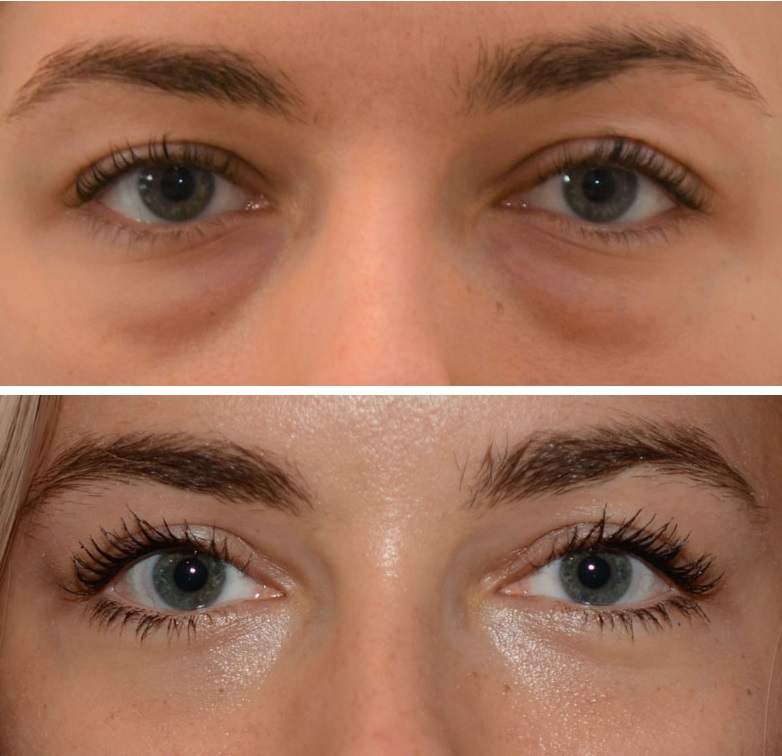 بهترین کلینیک بلفاروپلاستی تهرانسر