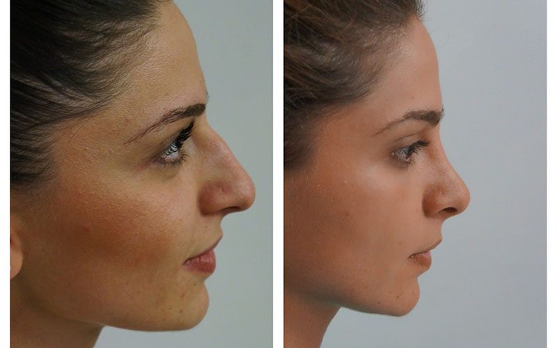 قیمت عمل بینی در سال ۱۴۰۴