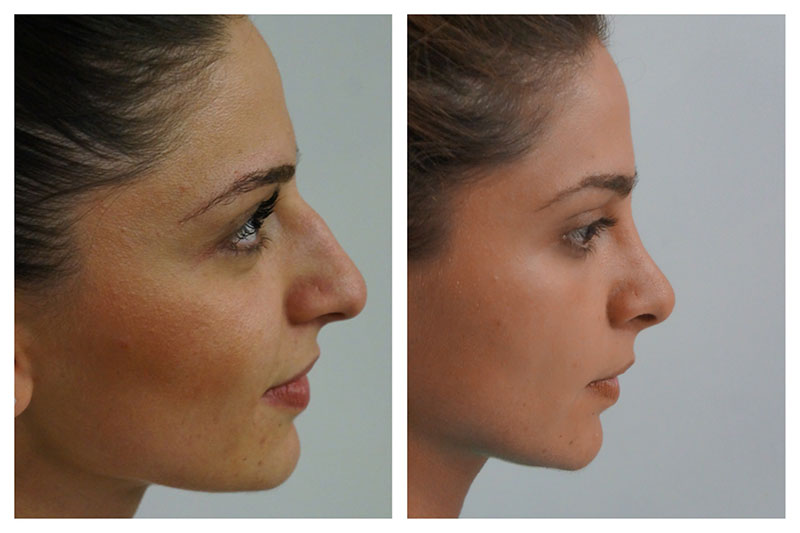 قیمت عمل بینی در سال ۱۴۰۴