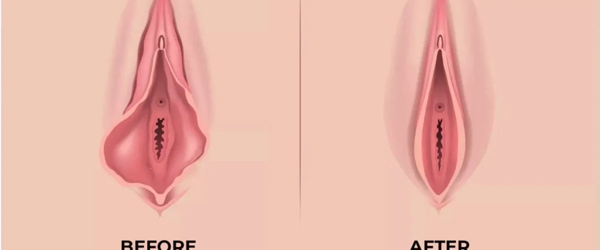 بزرگی لبه‌ های واژن نشانه چیست