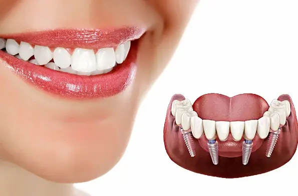 مراقبت بعد از ایمپلنت دندان