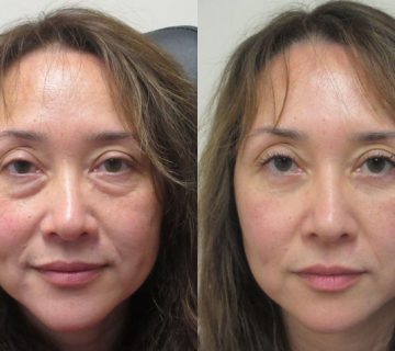 نابودی پف زیر چشم بعد از ۴۰ سالگی