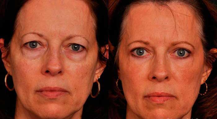 عمل بلفاروپلاستی پلک پایین چیست