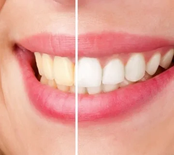 علت زرد شدن کامپوزیت دندان