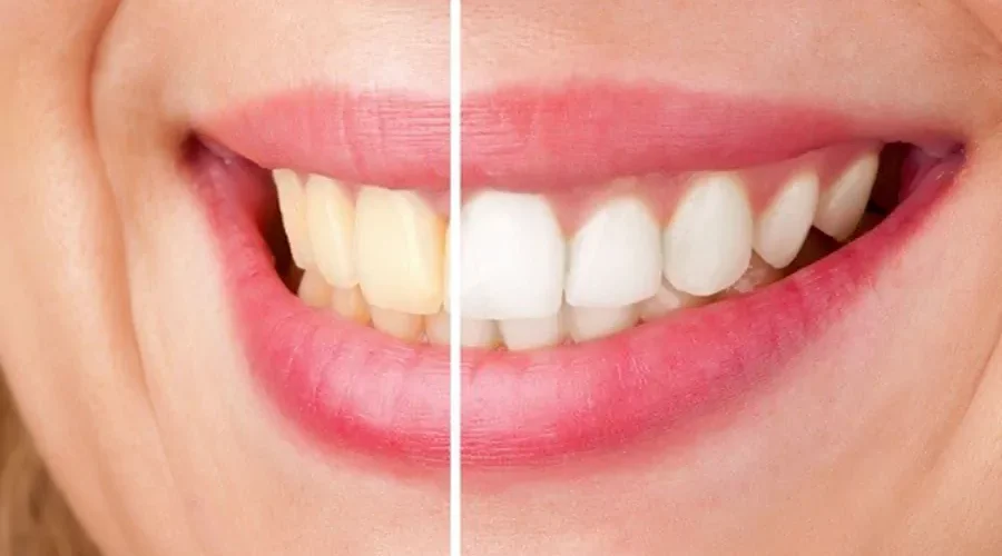 علت زرد شدن کامپوزیت دندان