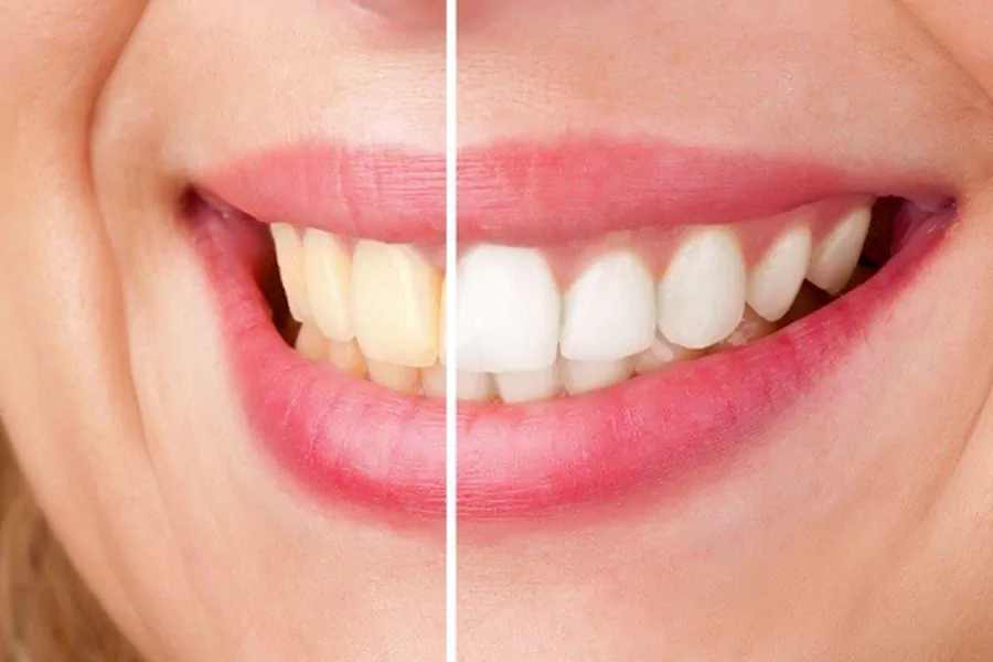 علت زرد شدن کامپوزیت دندان