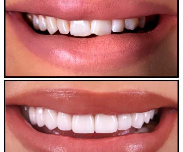 فرق کامپوزیت و لمینت دندان چیست