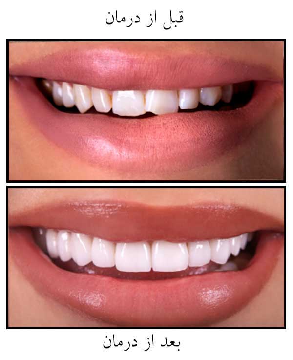 فرق کامپوزیت و لمینت دندان چیست