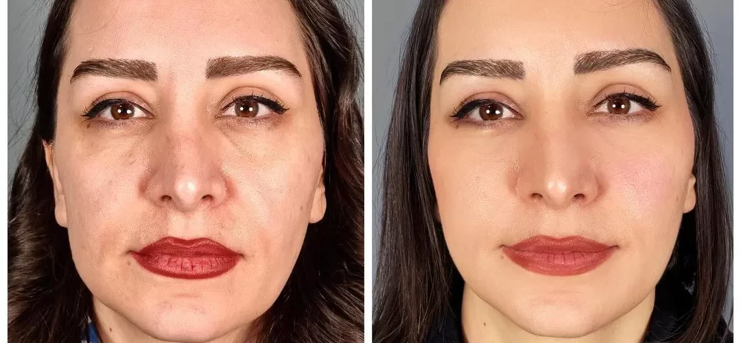 ترند های عمل زیبایی صورت در سال ۱۴۰۴