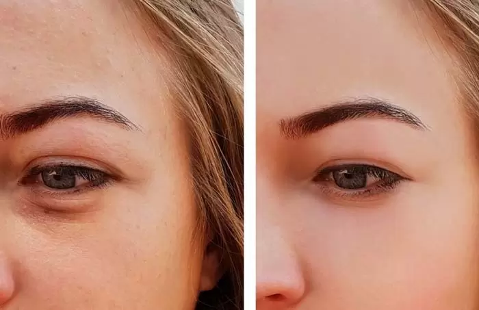 عمل بلفاروپلاستی پلک پایین چیست