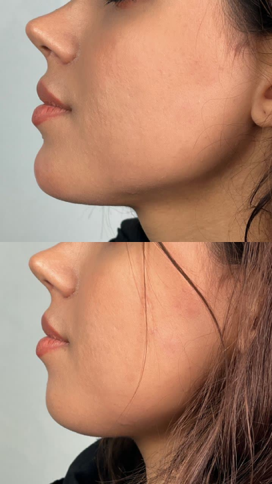 فیلر های ترکیبی چانه و گونه در تهرانسر 2 فیلر های ترکیبی چانه و گونه