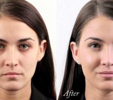 فیلر های ترکیبی چانه و گونه