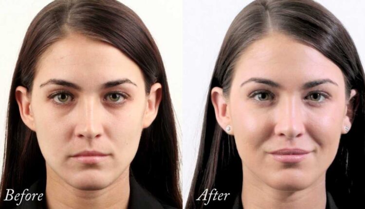 فیلر های ترکیبی چانه و گونه