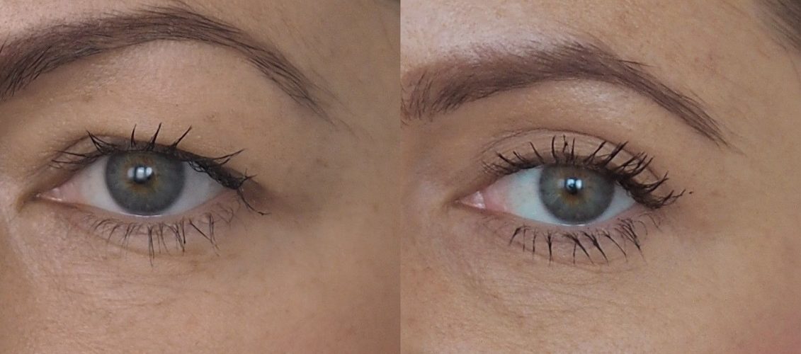 ماندگاری بلفاروپلاستی چقدر است؟