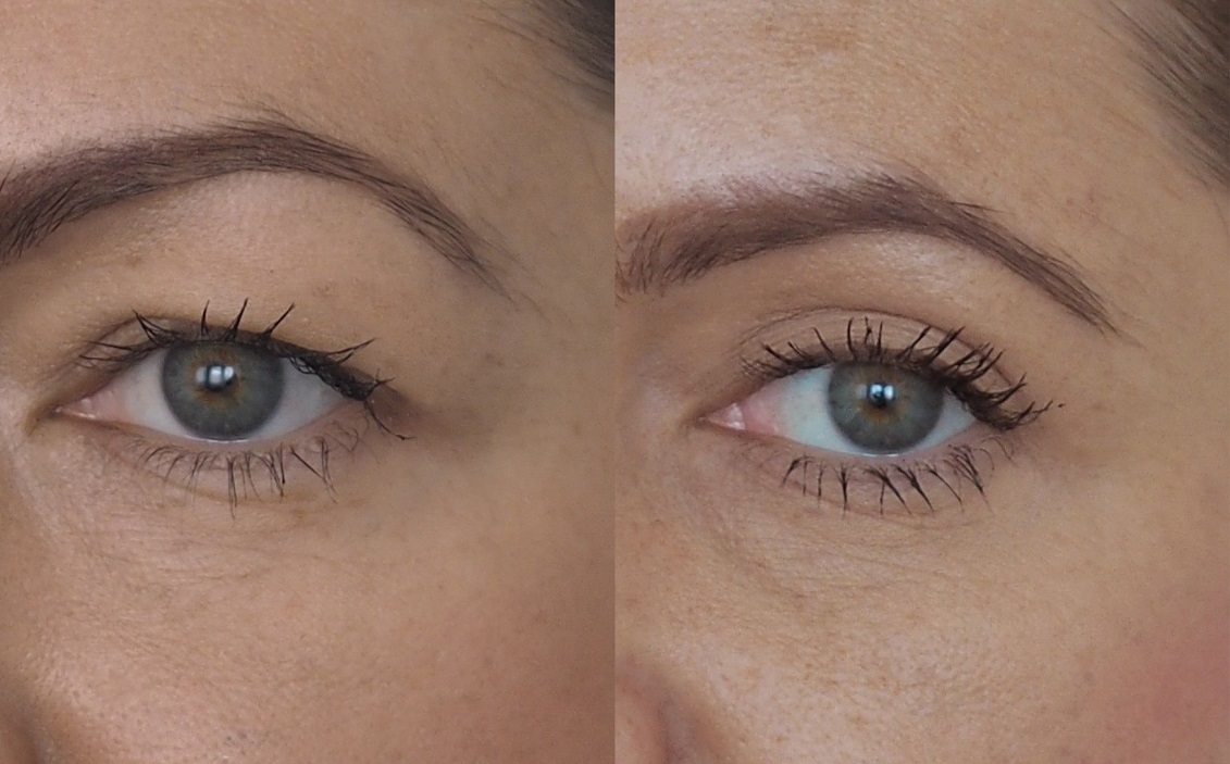 ماندگاری بلفاروپلاستی چقدر است؟