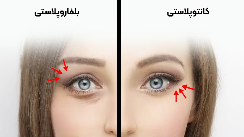 تفاوت کانتوپلاستی و بلفاروپلاستی