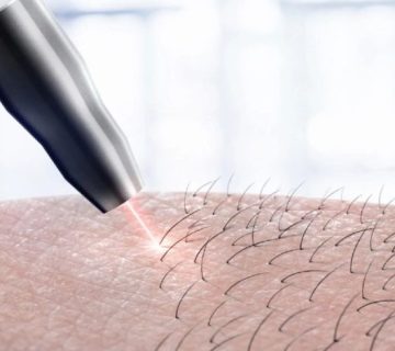 چرا لیزر بیکینی دیر جواب میده